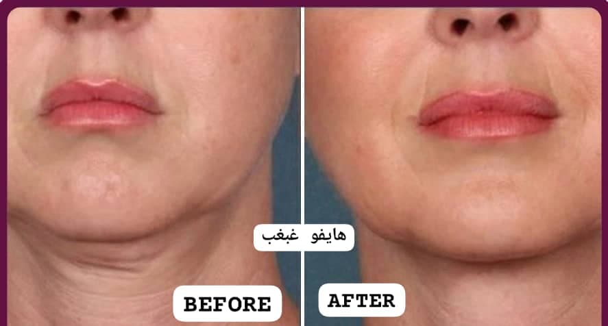 خدمات تخصصی پاکسازی پوست هایفوتراپی مزوتراپی مو و صورت فروزان خواجوی در اهواز