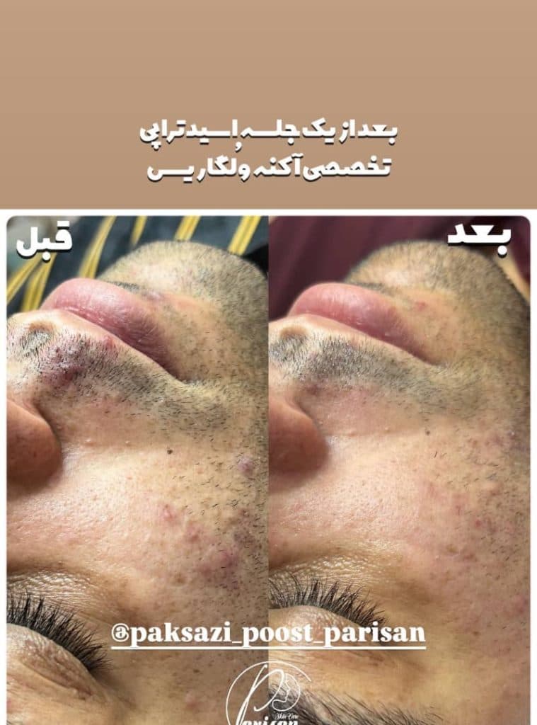 پاکسازی پوست پریسان در اراک