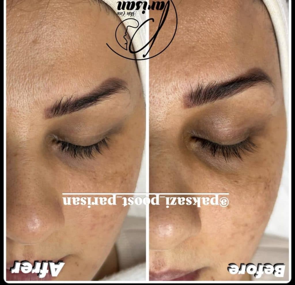 پاکسازی پوست پریسان در اراک