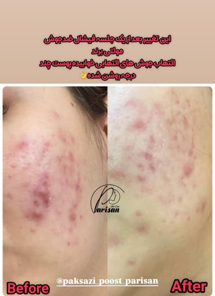 پاکسازی پوست پریسان در اراک