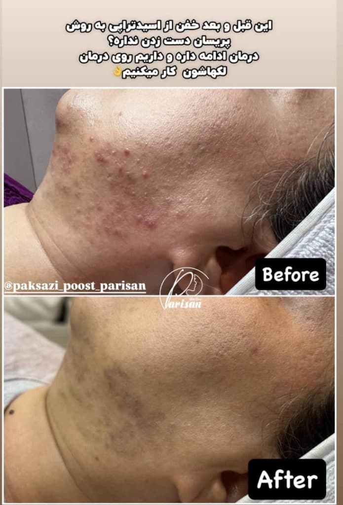 پاکسازی پوست پریسان در اراک
