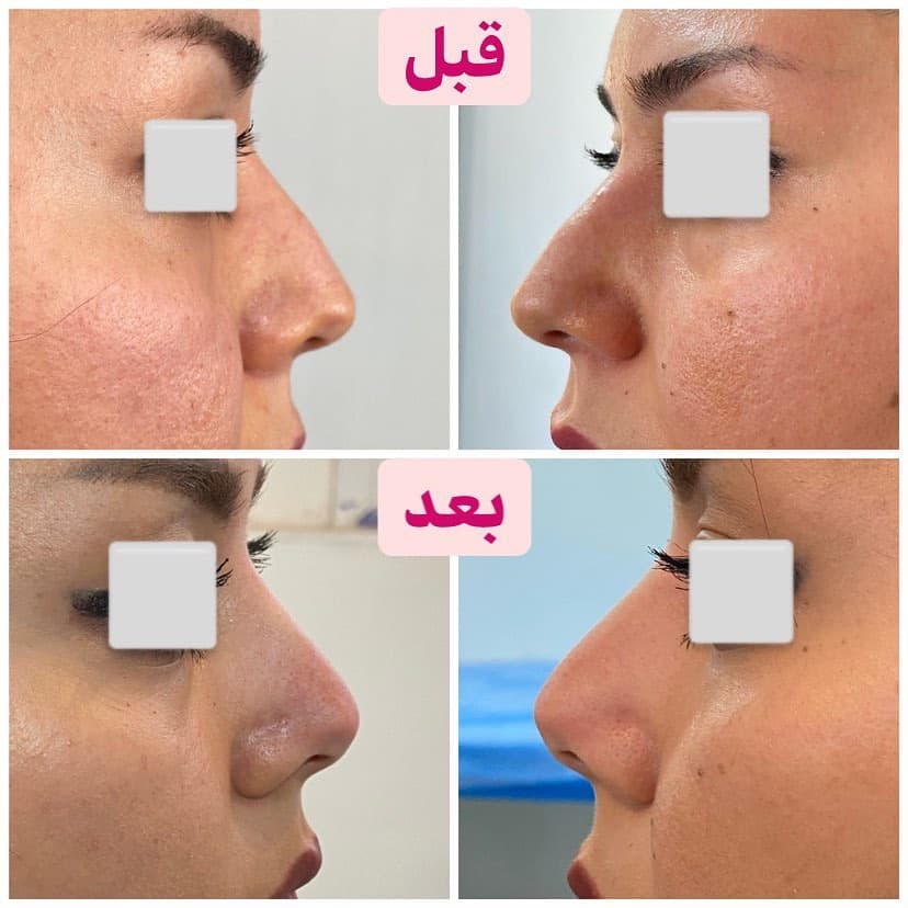 خدمات تخصصی زیبایی لیزر موهای زائد مرکز تخصصی ایپک در تبریز