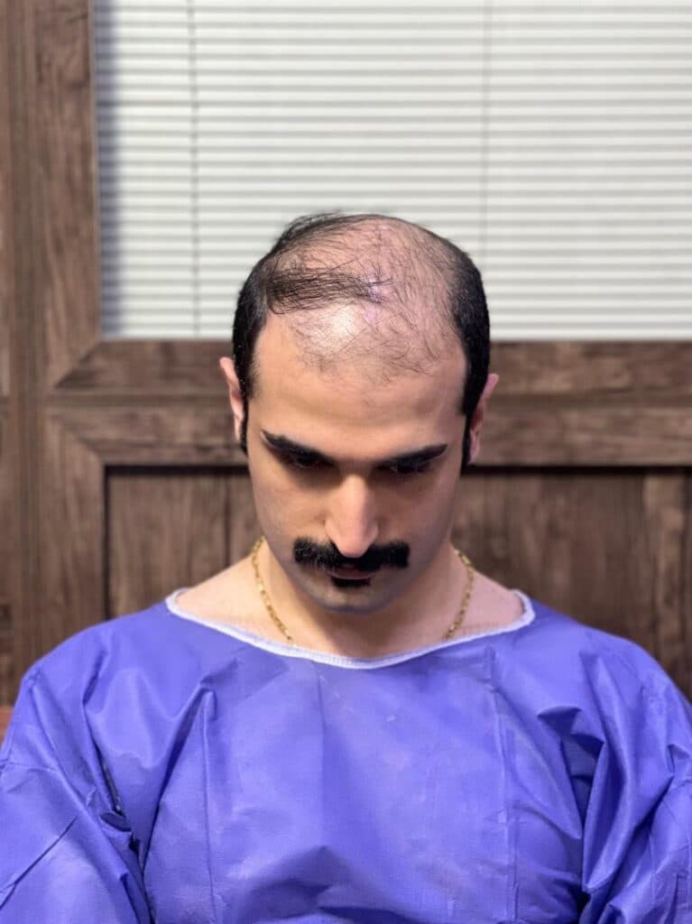 مرکز کاشت مو و ابرو ملیسا در زعفرانیه