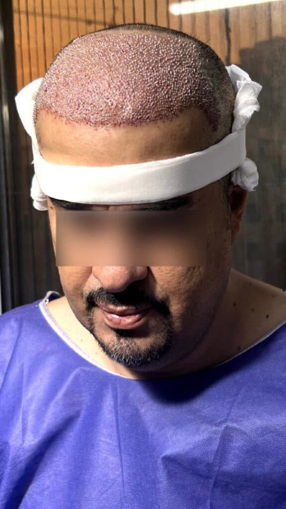 مرکز کاشت مو و ابرو ملیسا در زعفرانیه