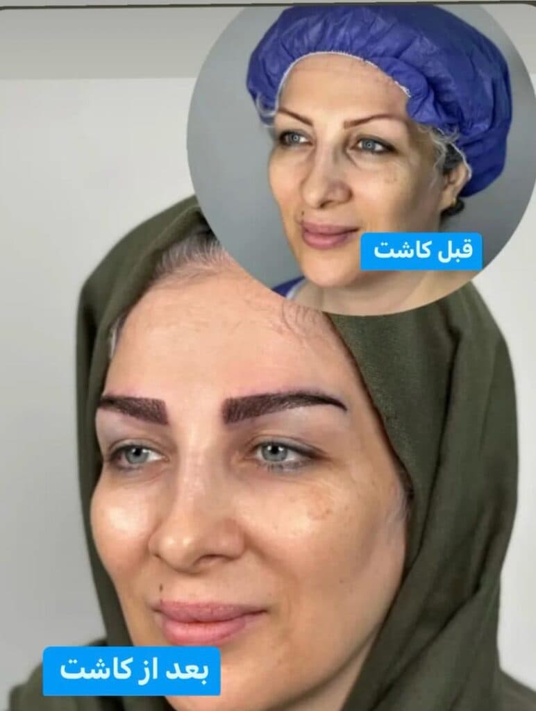 مرکز کاشت مو و ابرو ملیسا در زعفرانیه