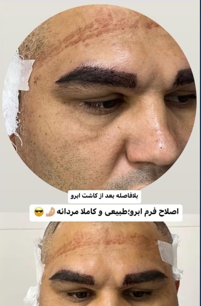 مرکز کاشت مو و ابرو ملیسا در زعفرانیه