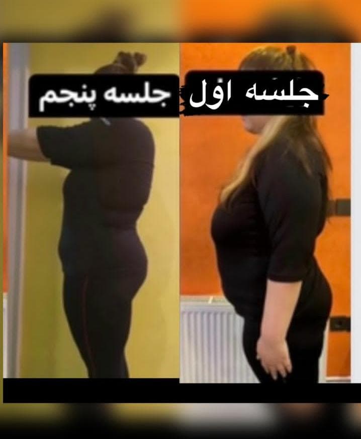 ایکس بادی لاغری ems در ونک و فرشته تهران