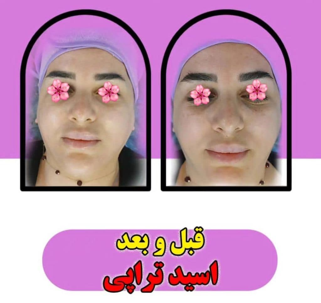 خدمات تخصصی پاکسازی پوست و فیشیال صورت شادی ملکشاهی در اصفهان
