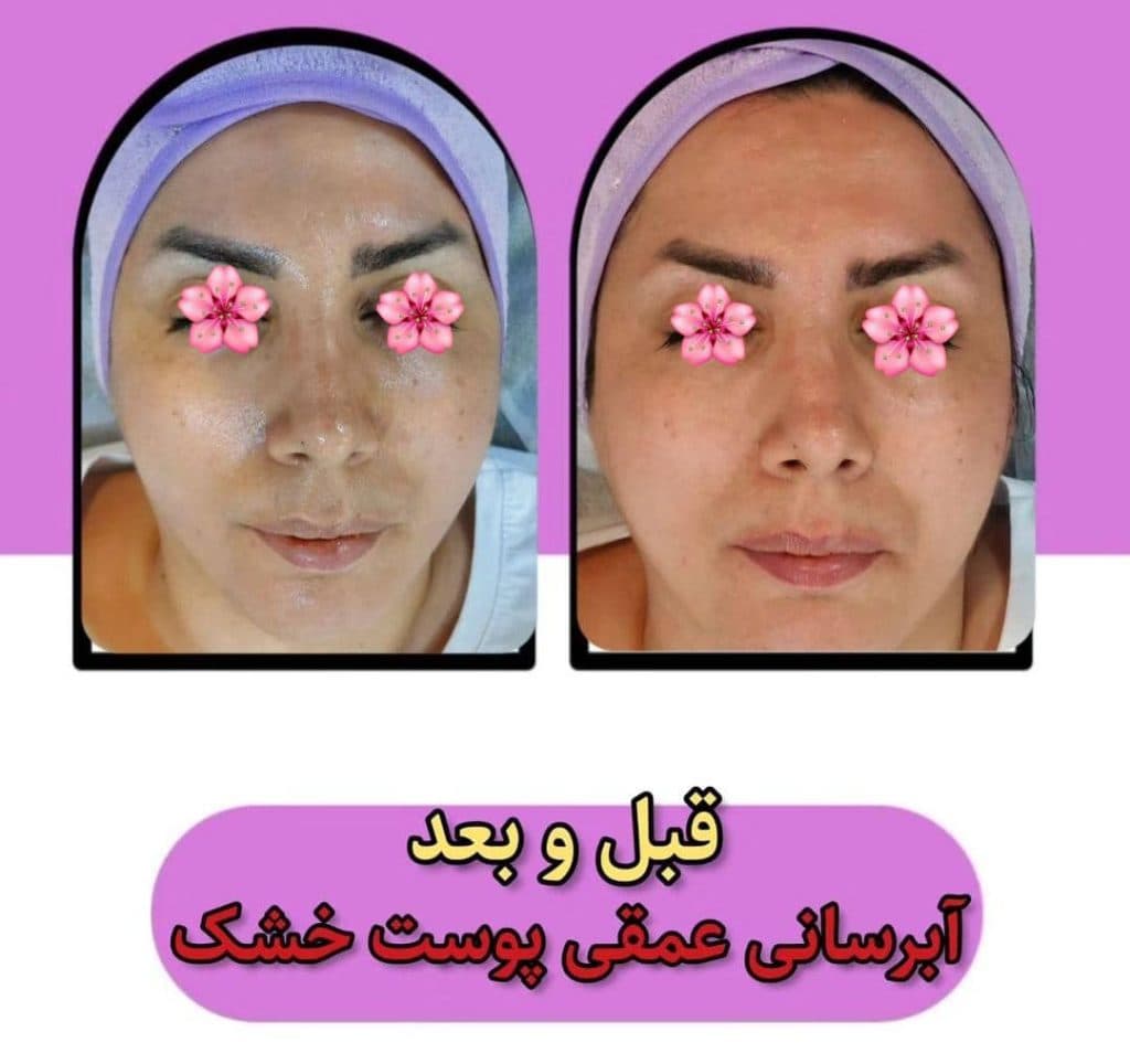 خدمات تخصصی پاکسازی پوست و فیشیال صورت شادی ملکشاهی در اصفهان