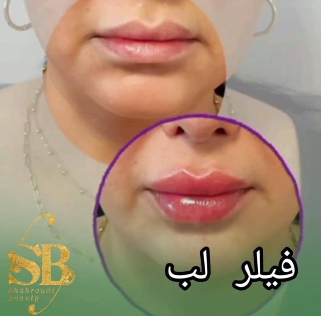 خدمات تخصصی تزریق فیلر لب روسی شاهرودی طب در سعادت آباد تهران