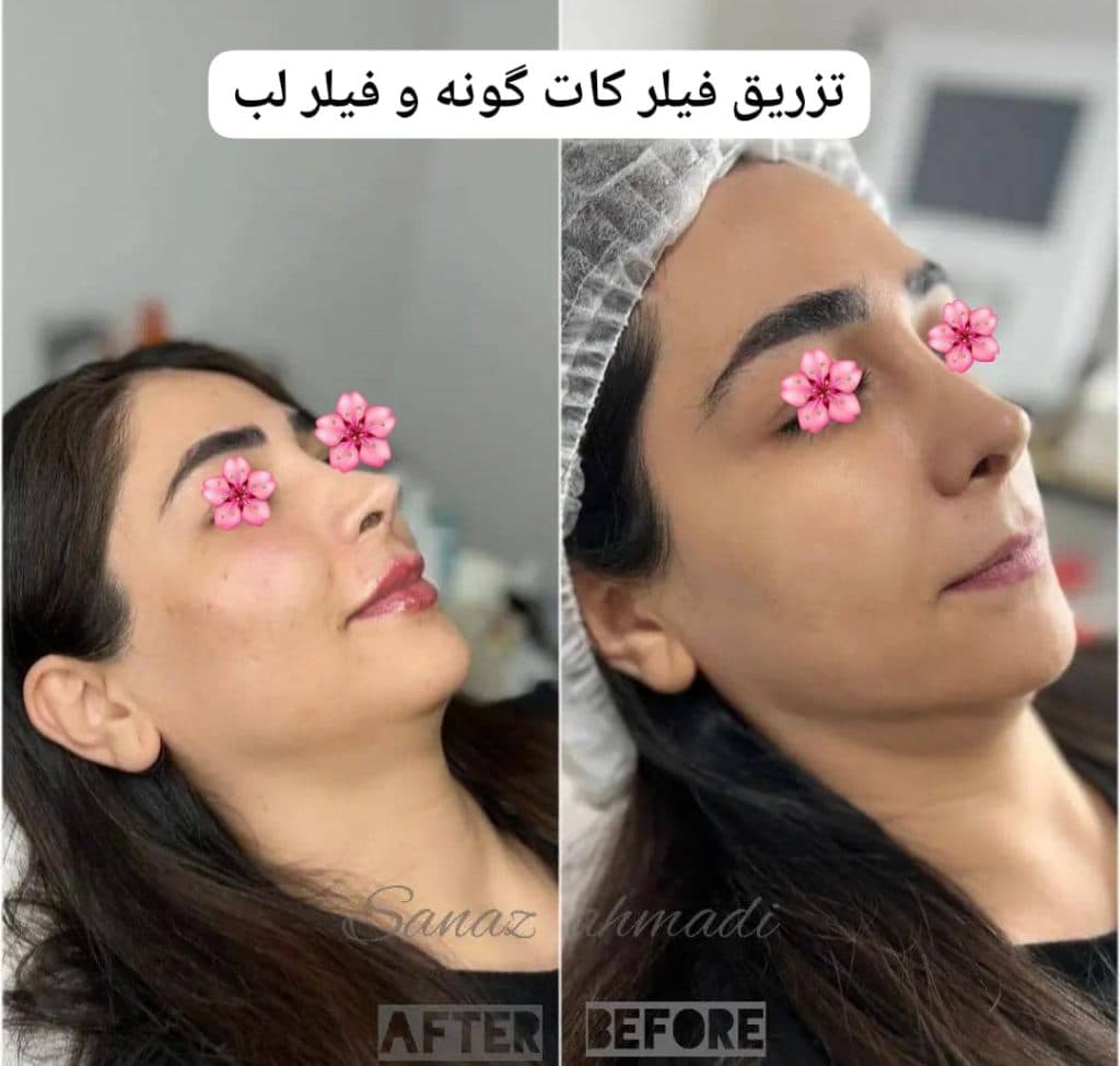 آموزش و خدمات تخصصی تزریق فیلر لب روسی و بوتاکس ساناز احمدی در پرند