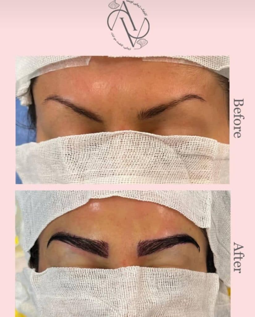 کلینیک زیبایی کاشت مو اویسا در شیراز