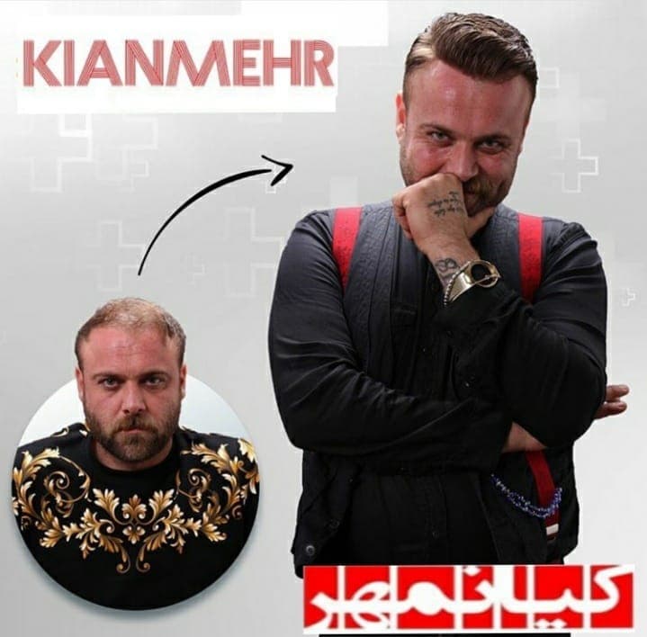 کاشت مو کیانمهر در ارومیه