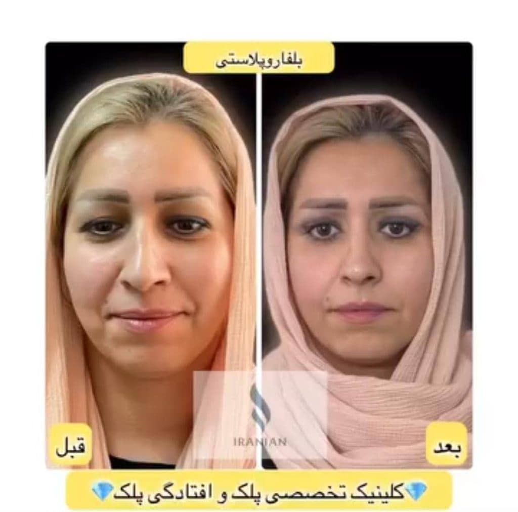 کلینیک تخصصی جراحی پلک ایرانیان در تهران