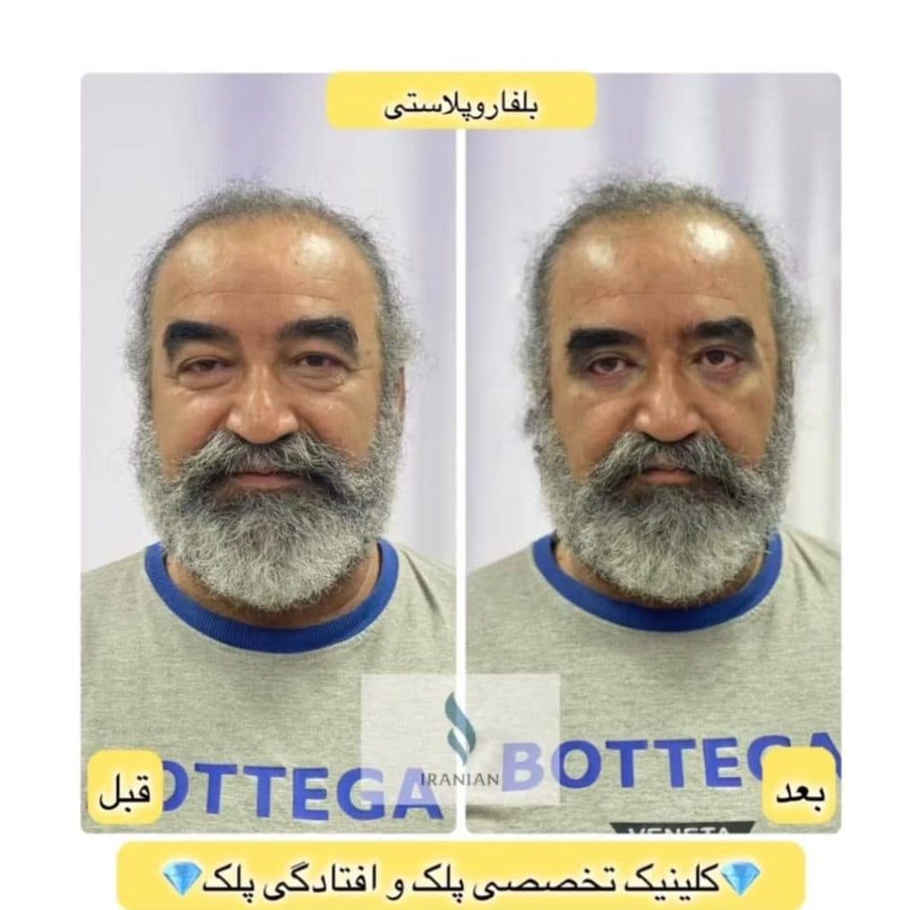 کلینیک تخصصی جراحی پلک ایرانیان در تهران