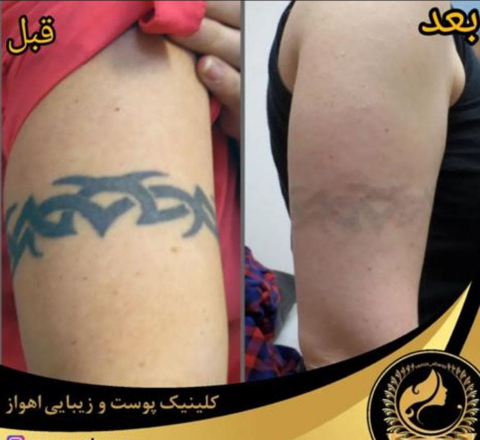 مرکز لیزر ونوس در نادری اهواز