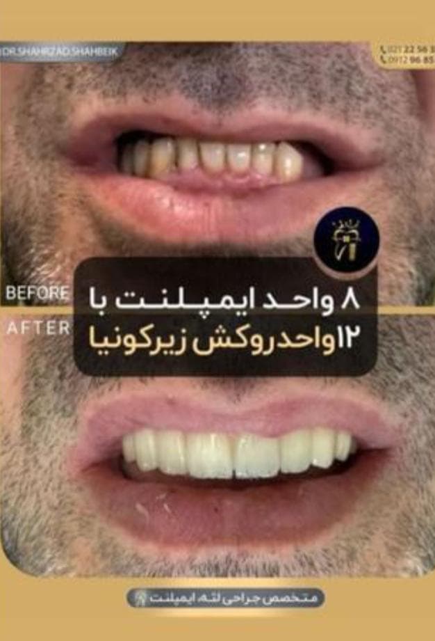 مرکز تخصصی ایمپلنت دندان دکتر شهرزاد شاه بیک در پاسداران تهران