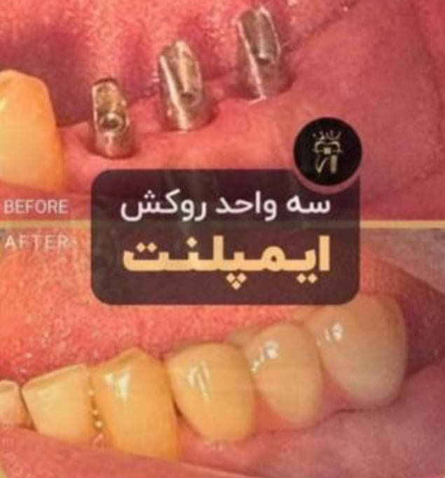 مرکز تخصصی ایمپلنت دندان دکتر شهرزاد شاه بیک در پاسداران تهران