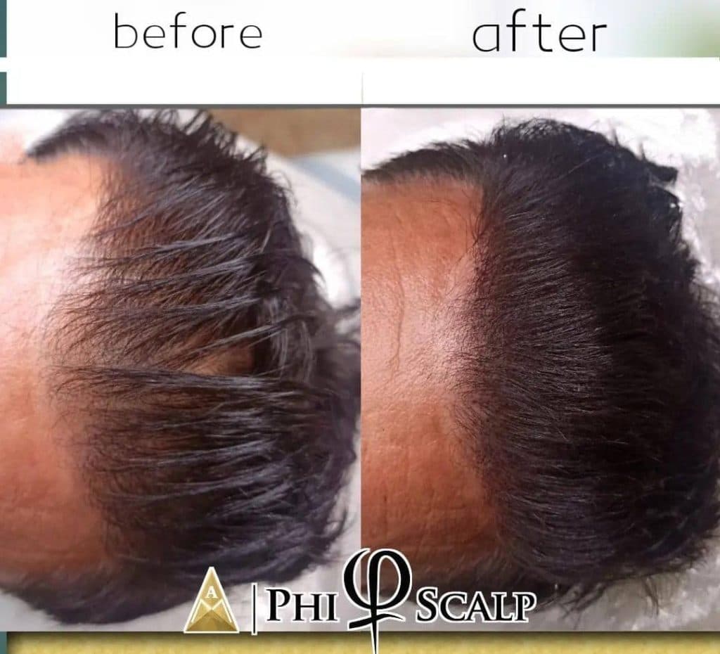 میکرواسکالپ سر پوریا گودرزی در شیراز
