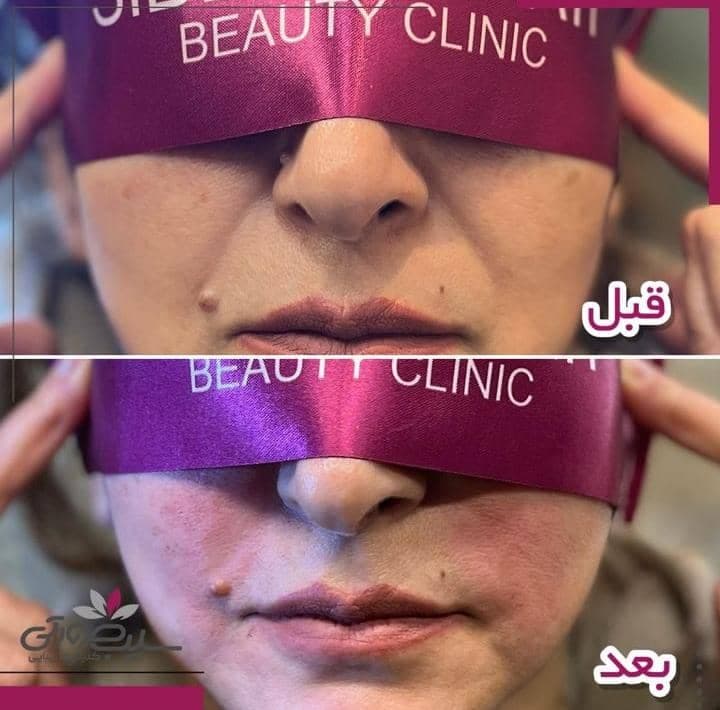 مرکز لیزر زیبایی سیب صورتی در ششم بهمن سنندج