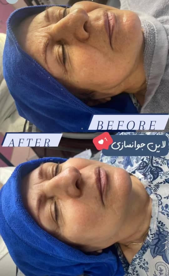 خدمات زیبایی و فیشیال پوست مهسا عبدالعلی زاده در تهران