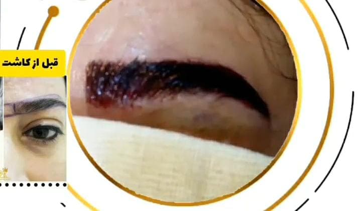 مرکز کاشت مو درمیس در کرمانشاه