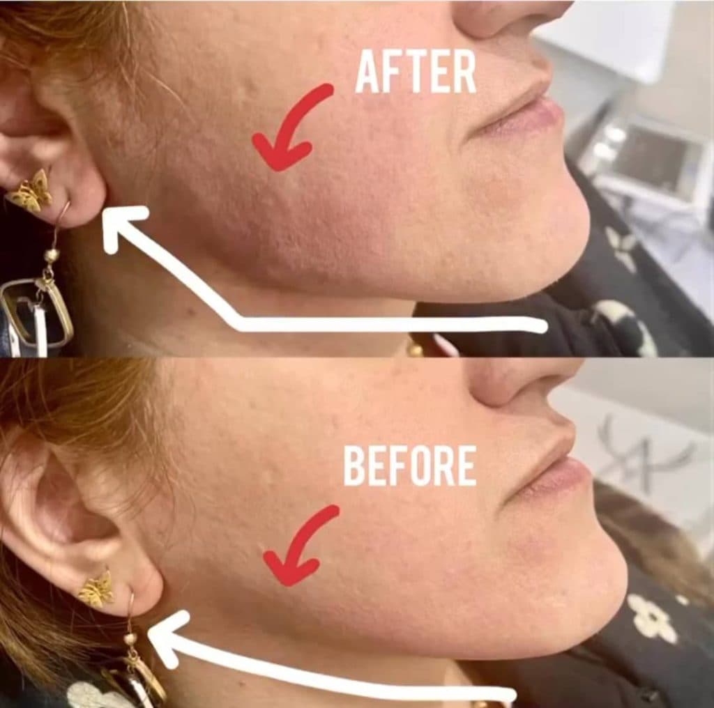مطب زیبایی تزریق ژل لب روسی لیلا شرقی در تبریز