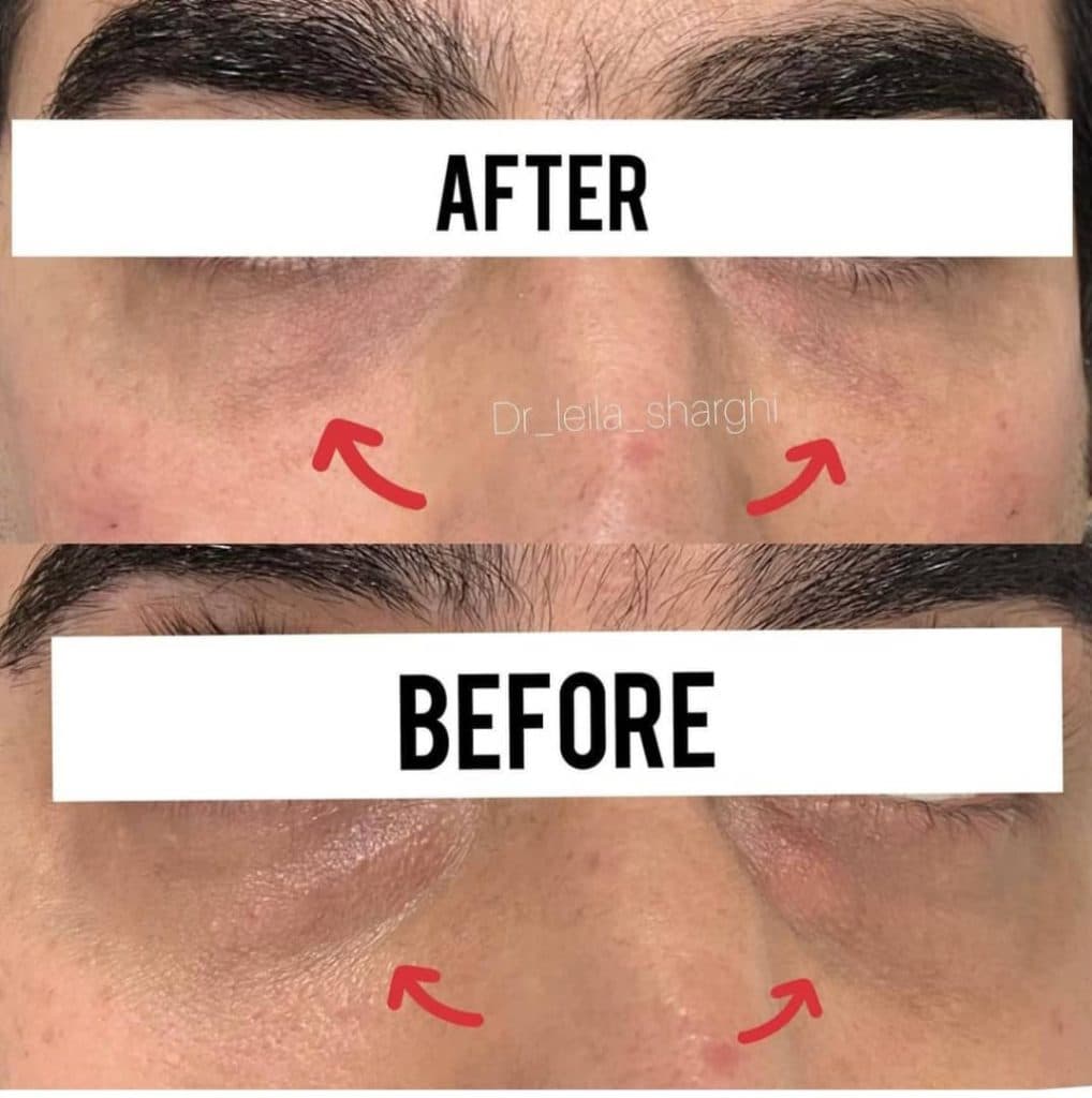 مطب زیبایی تزریق ژل لب روسی لیلا شرقی در تبریز