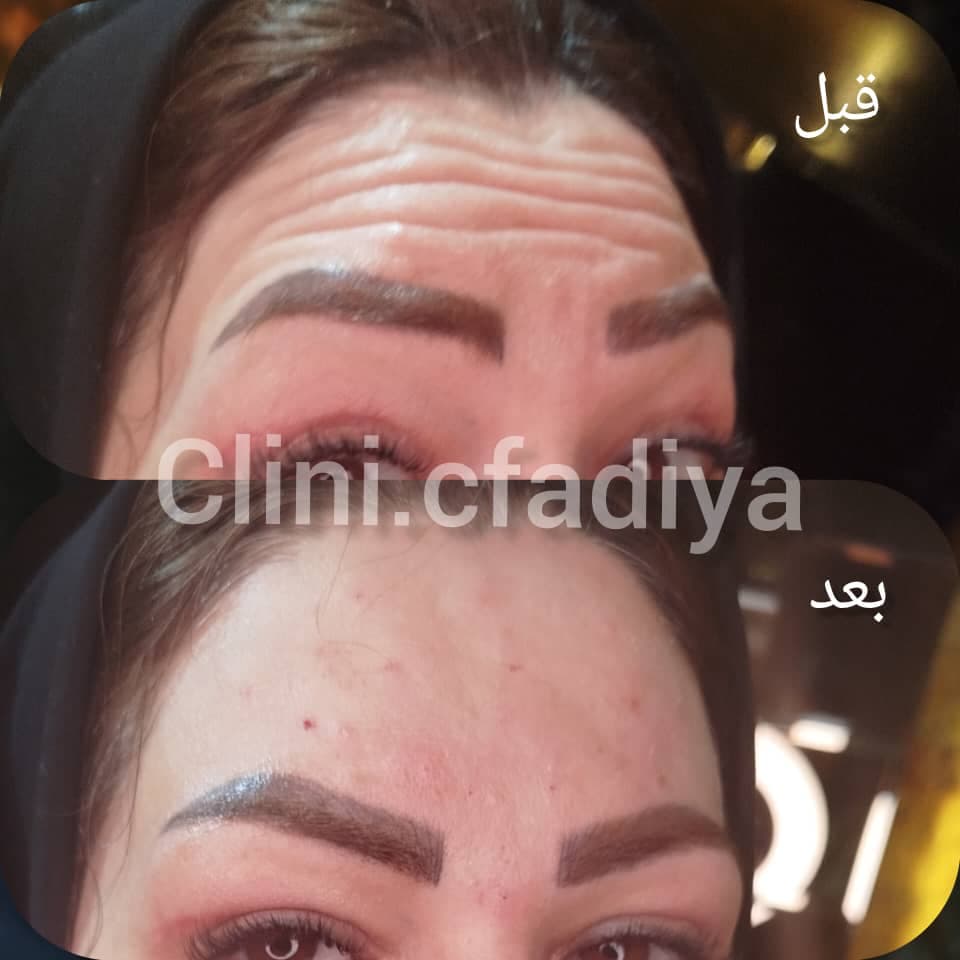 خدمات تخصصی تزریق ژل و بوتاکس فاطمه خاکراه در شیخ صدوقی مشهد