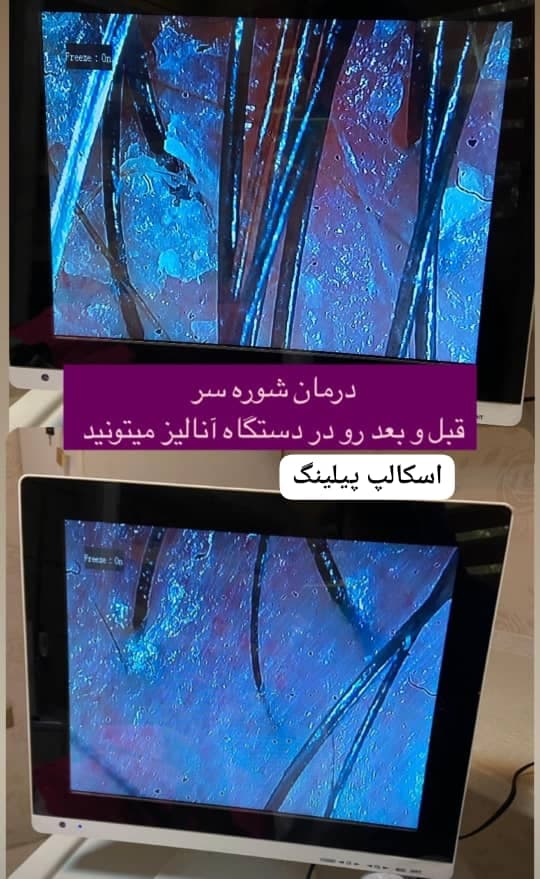 آموزش و خدمات تخصصی پاکسازی پوست پرین در شاهین شهر