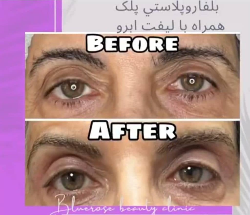 مرکز لیزر رز آبی در سعادت آباد تهران
