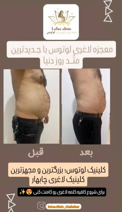 کلینیک زیبایی لاغری لوتوس در چابهار