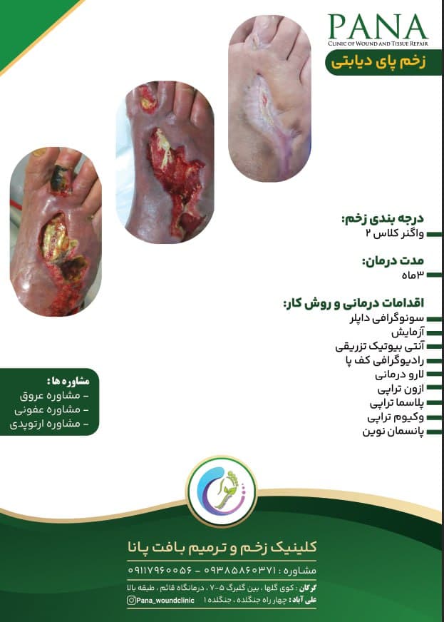 کلینیک درمان زخم دیابت پانا گرگان