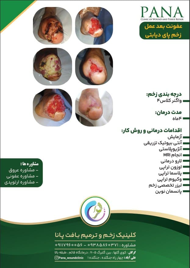 کلینیک درمان زخم دیابت پانا گرگان