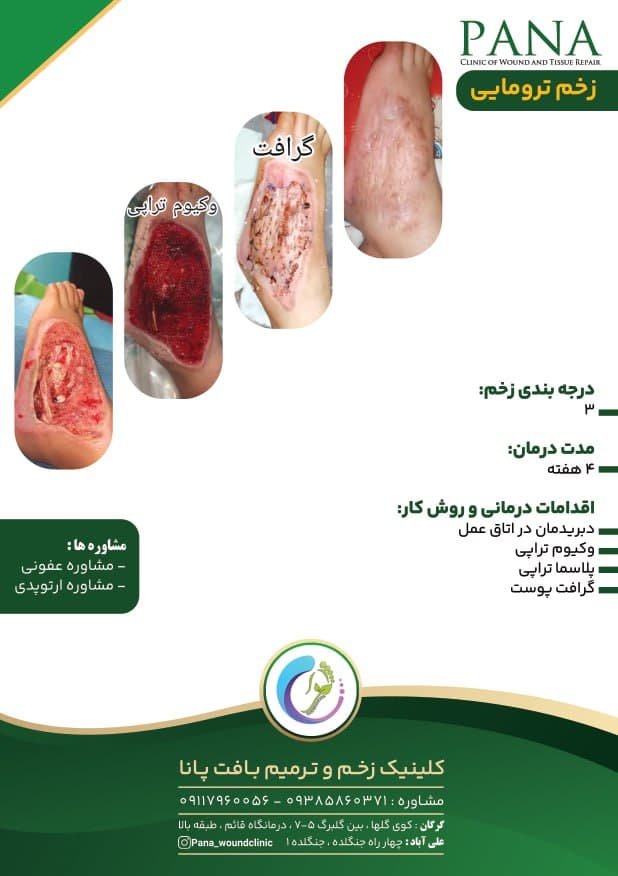 کلینیک درمان زخم دیابت پانا گرگان
