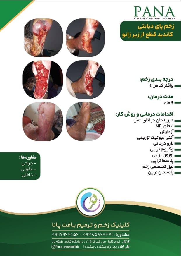 کلینیک درمان زخم دیابت پانا گرگان
