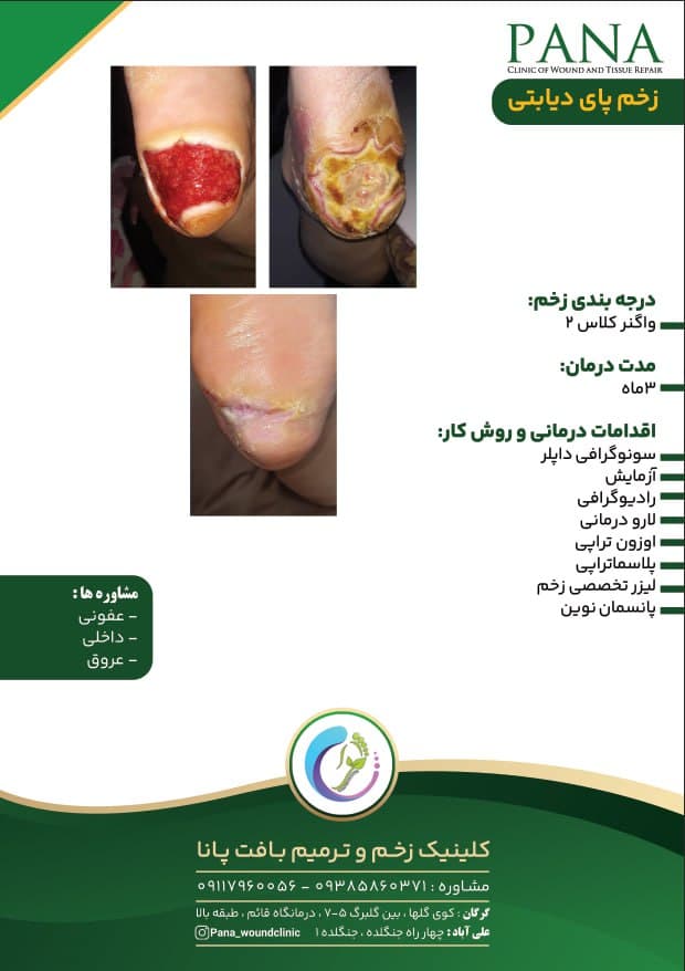 کلینیک درمان زخم دیابت پانا گرگان
