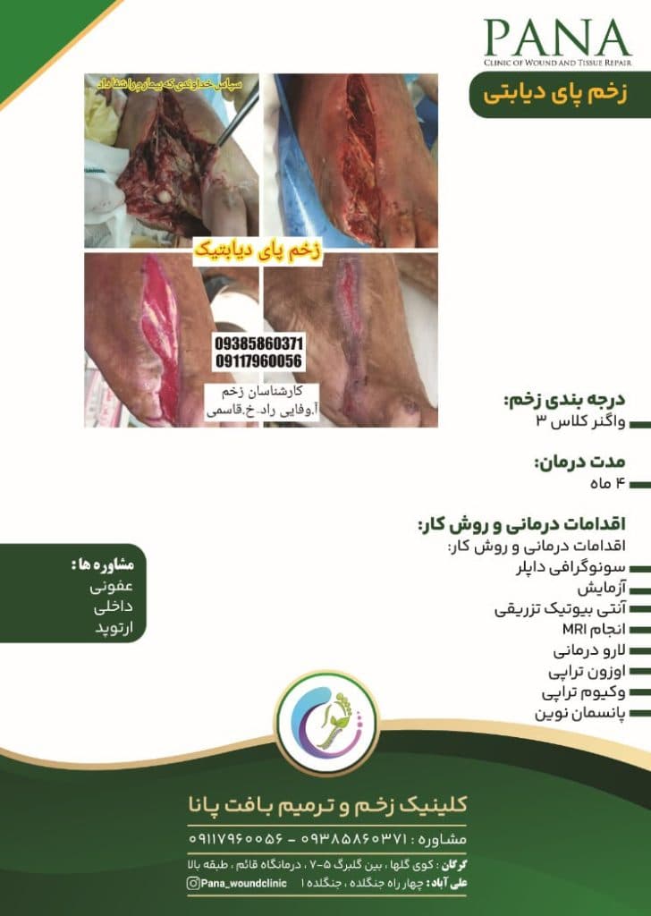 کلینیک درمان زخم دیابت پانا گرگان
