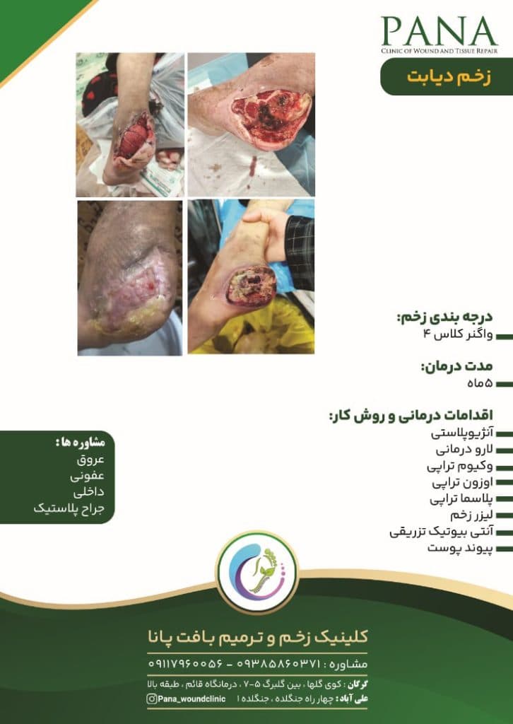 کلینیک درمان زخم دیابت پانا گرگان