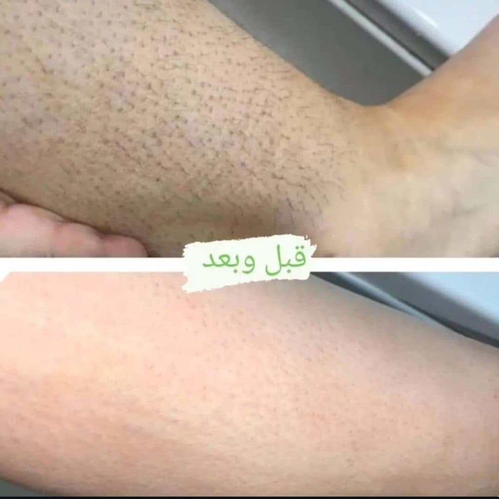 مرکز لیزر ملکه در چابهار