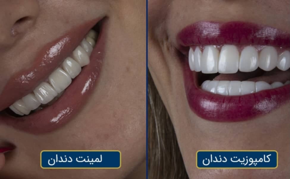طراحی و اجرای زیبایی دندان و کامپوزیت مازدنت در کرمانشاه