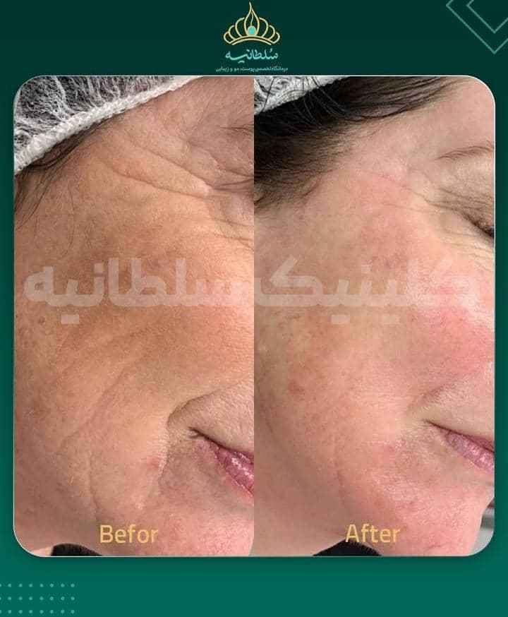 کلینیک کاشت مو سلطانیه در حافظیه شیراز
