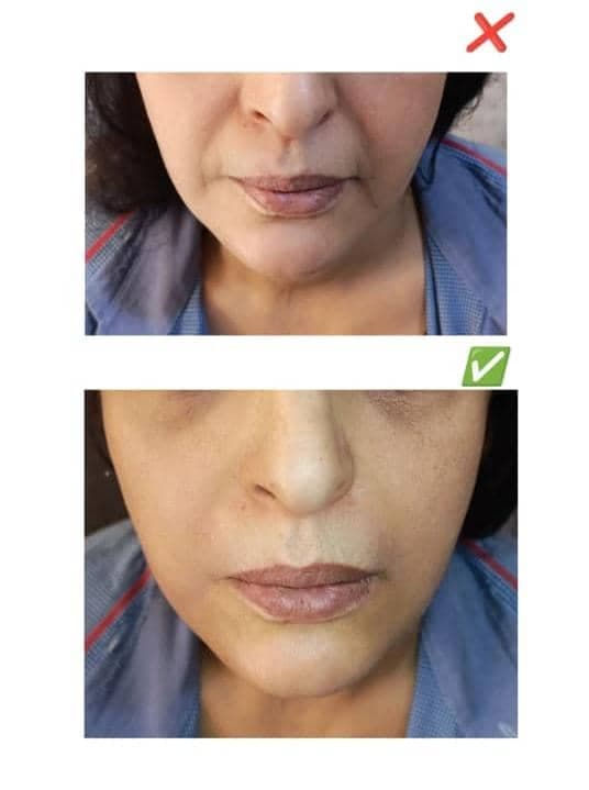 تزریق ژل و بوتاکس آیسان در عباس آباد