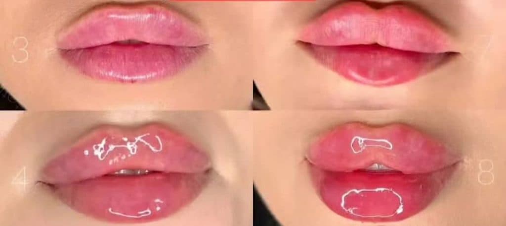 تزریق ژل و بوتاکس آیسان در عباس آباد