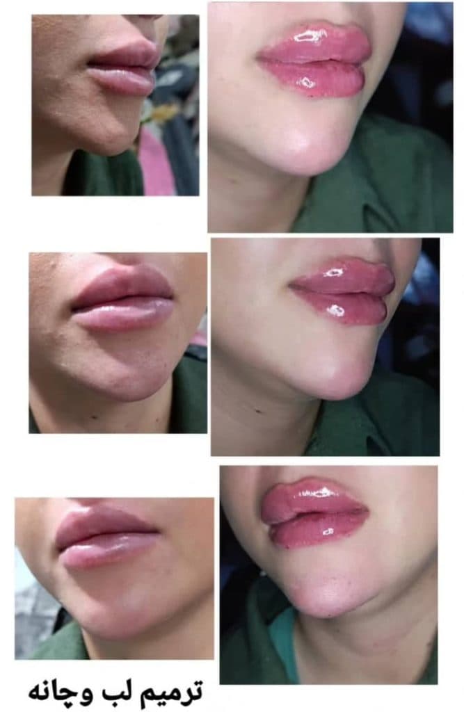 تزریق ژل و بوتاکس آیسان در عباس آباد
