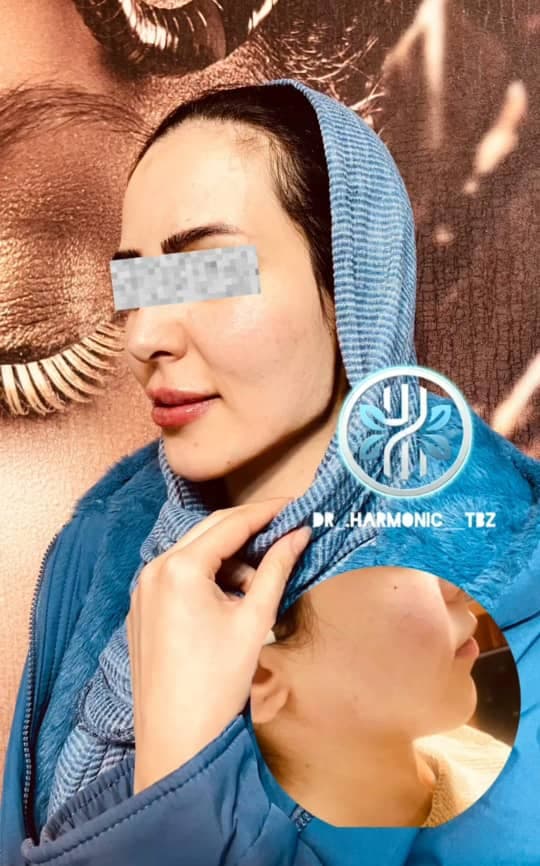 مرکز تخصصی تزریق ژل و بوتاکس دکتر عادل علیزاده ولیعصر تبریز