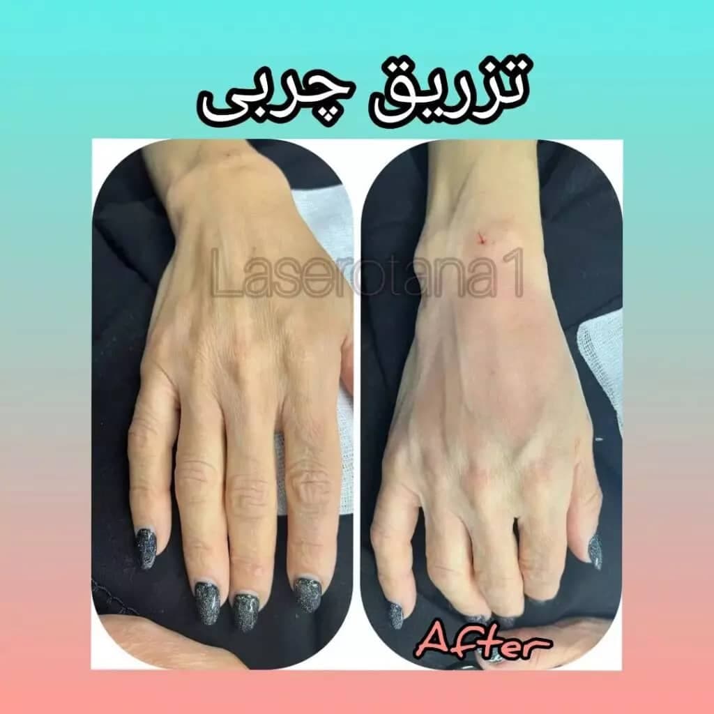 مرکز تخصصی لیزر موهای زائد اوتانا در سعادت آباد تهران