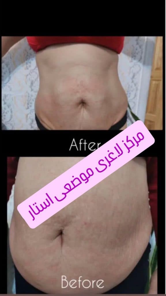 مرکز لاغری موضعی استار در رشت