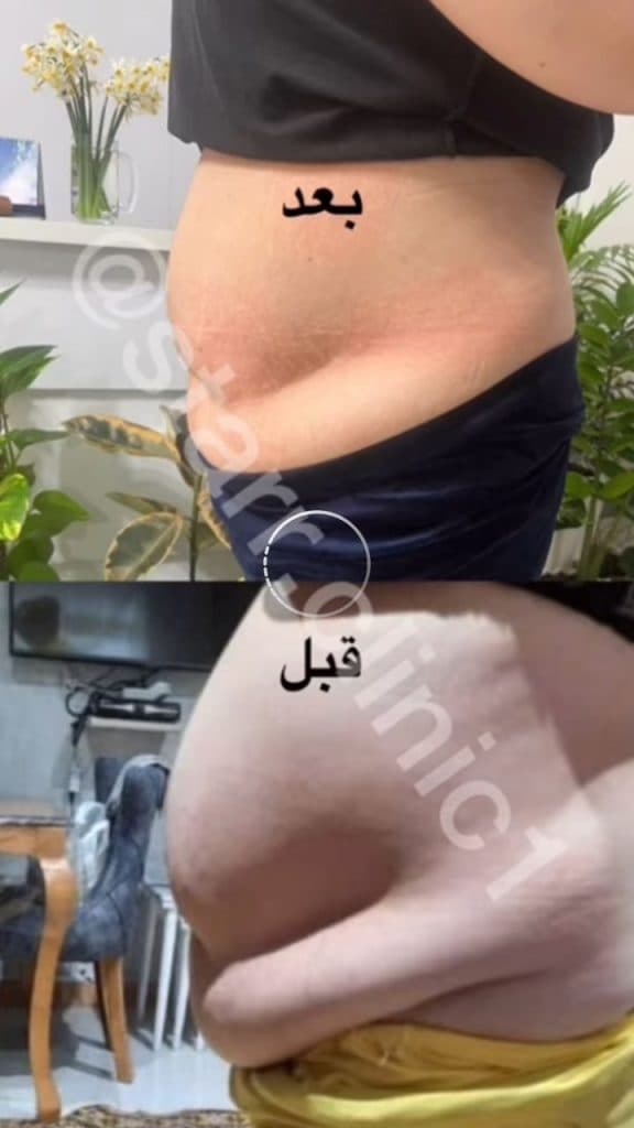 مرکز لاغری موضعی استار در رشت