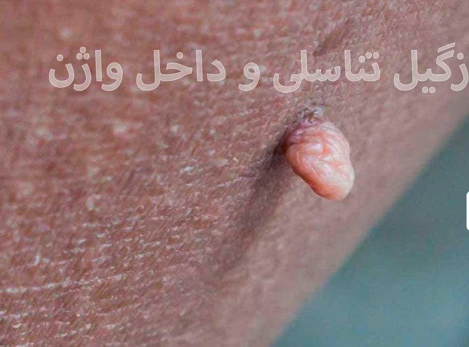 مطب درمان زگیل تناسلی زینب بهاروند در خرم آباد